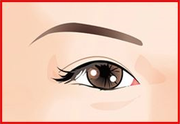 Non-incisional Double eyelid surgery 