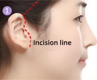 Incision is made from scalp of side head and goes along the ear and then it ends at the back of earlobe.